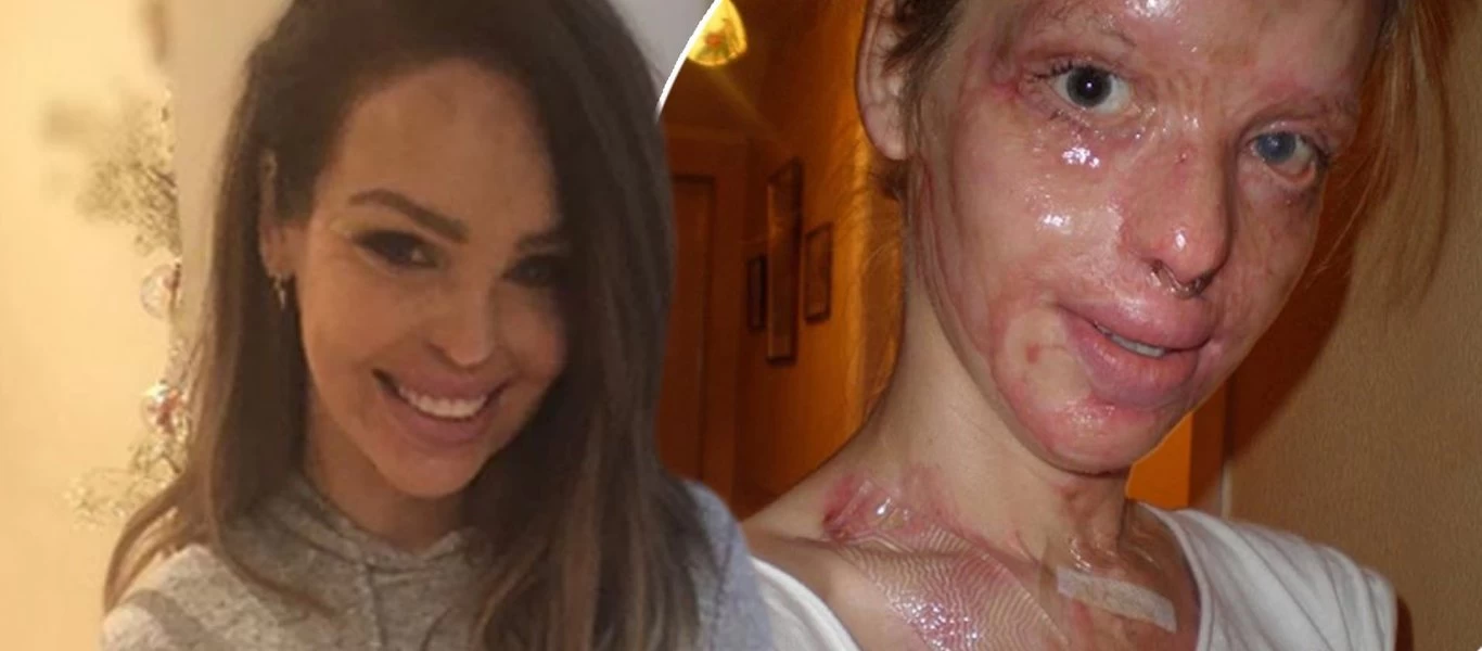 Η επίθεση με οξύ στην 24χρονη Katie Piper: Τα 40 χειρουργεία & το θαύμα της αποκατάστασης (βίντεο)